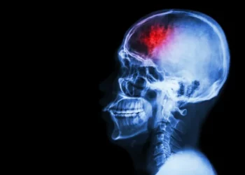 Study Shows Likelihood of Memory and Thinking Problems for Stroke Survivors


Photo Courtesy