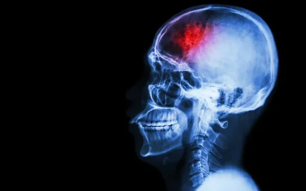 Study Shows Likelihood of Memory and Thinking Problems for Stroke Survivors


Photo Courtesy