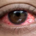 Red eye + Conjunctivitis