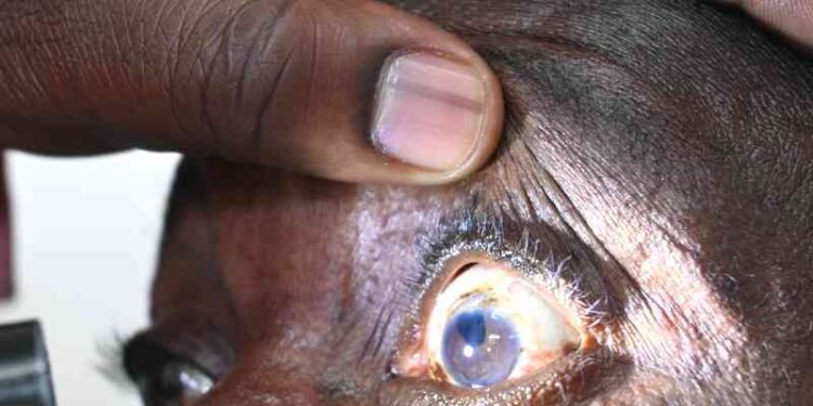 Red Eye Disease: Health Ministry Advises Kon What to Do