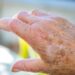 Eczema Changes with Age-Research

Photo Courtesy